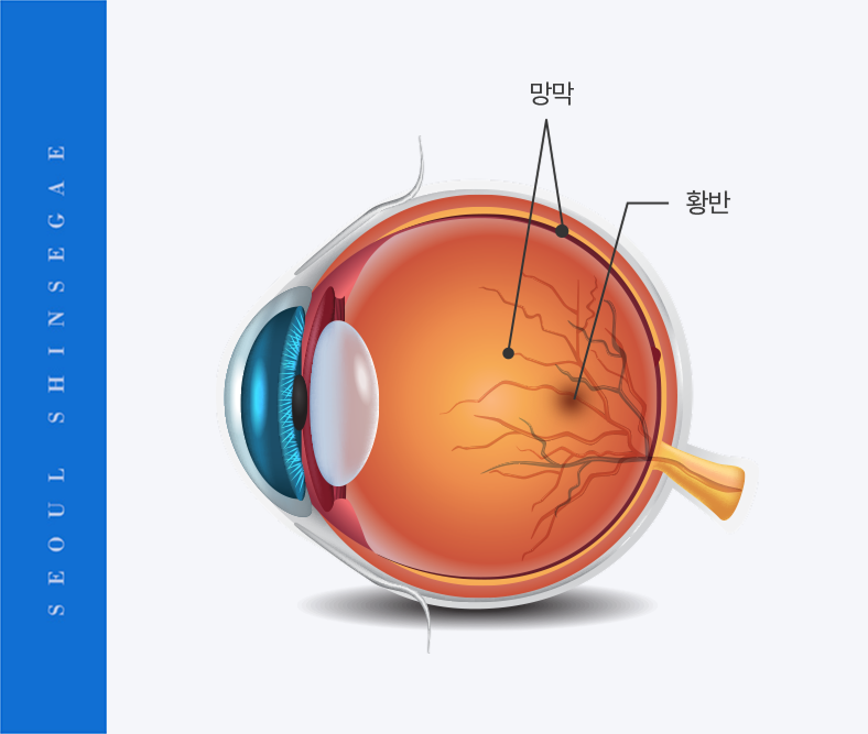 망막전막/황반원공