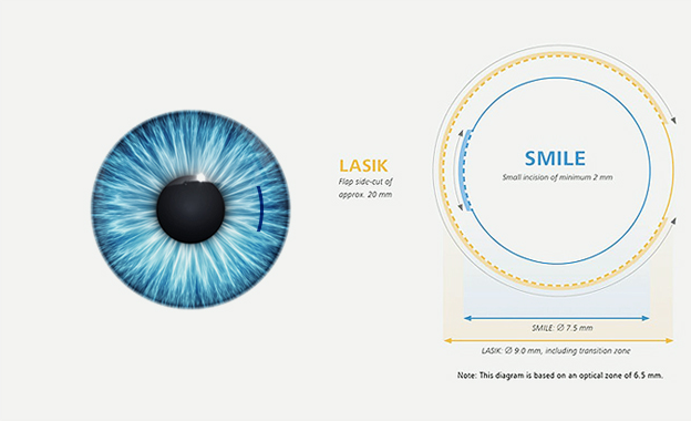 SMILE LASIK