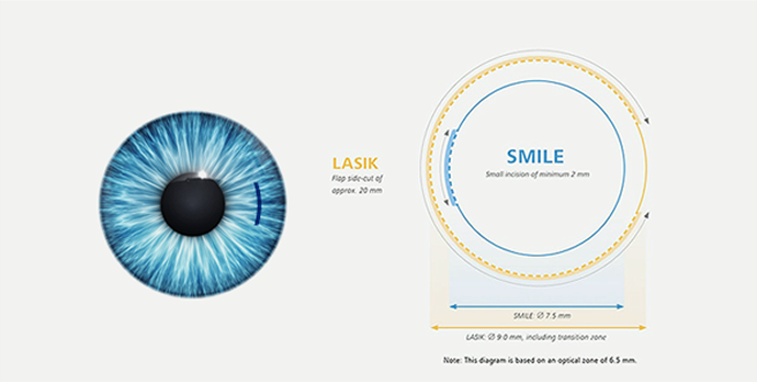 SMILE LASIK