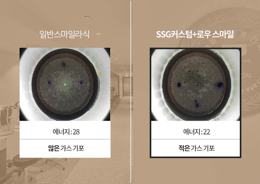 로우에너지 스마일라식