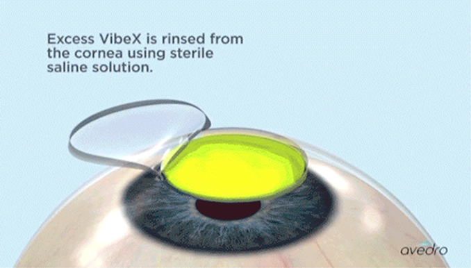 Excess VibeX is rinsed from the cornea using sterile saline solution.