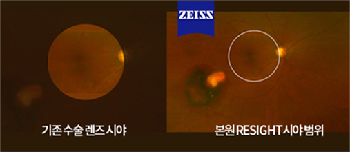 ZEISS ReSIGHT