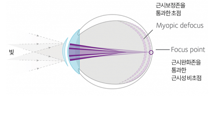 근시보정존을 통과한 초점 Myopic defocus, 근시완화존을 통과한 근시성 비초점 Focus point